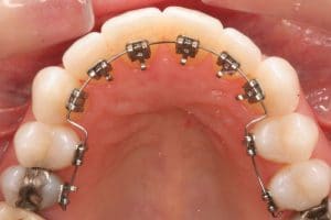 Orthodontie Linguale